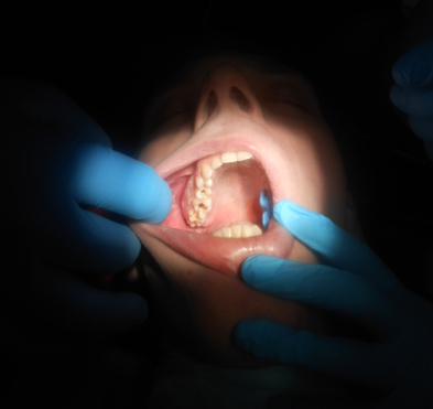 Лечение зубов под наркозом